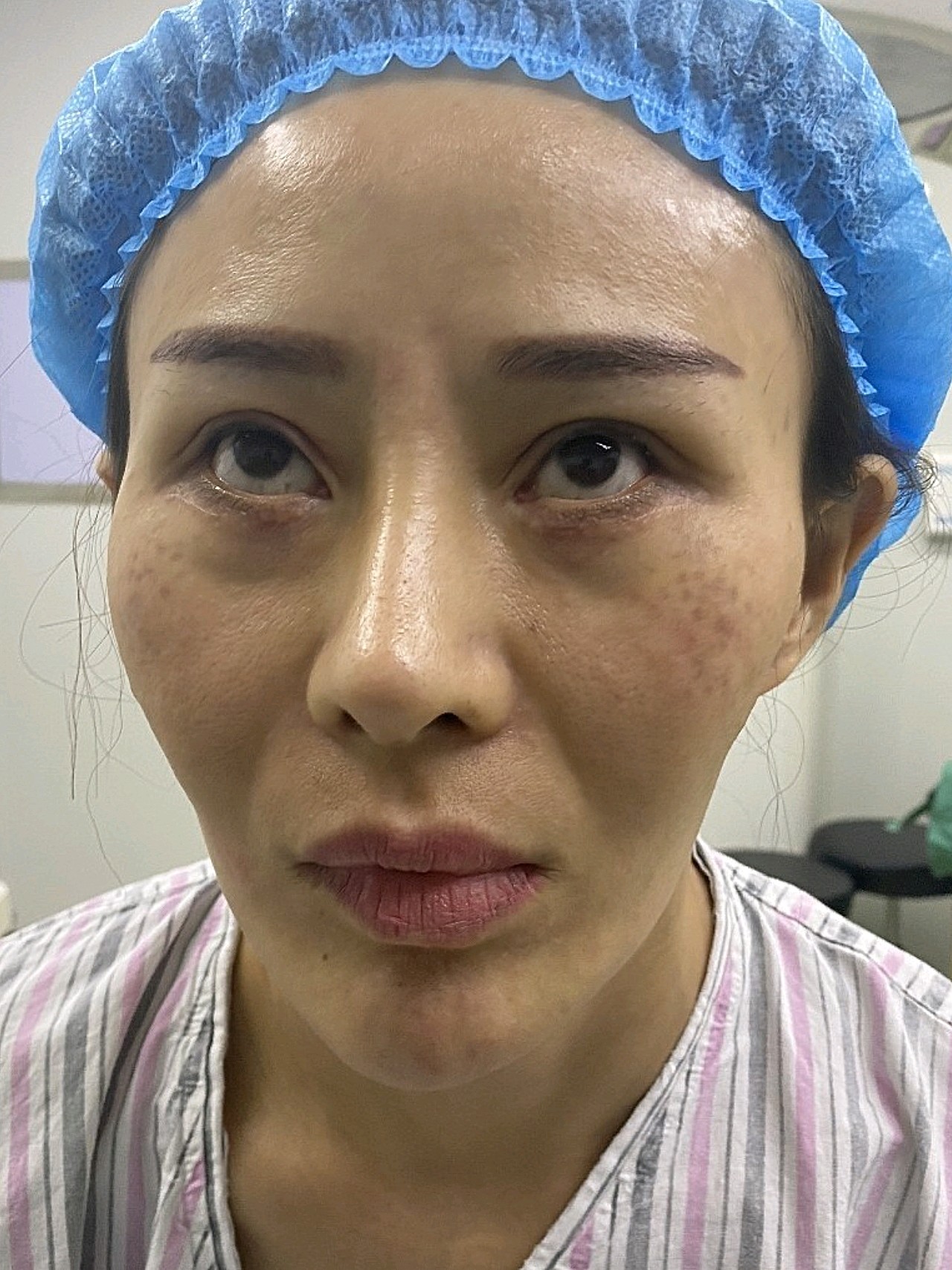 瘦脸针打了五次造成神经萎缩脂肪填充之后好美