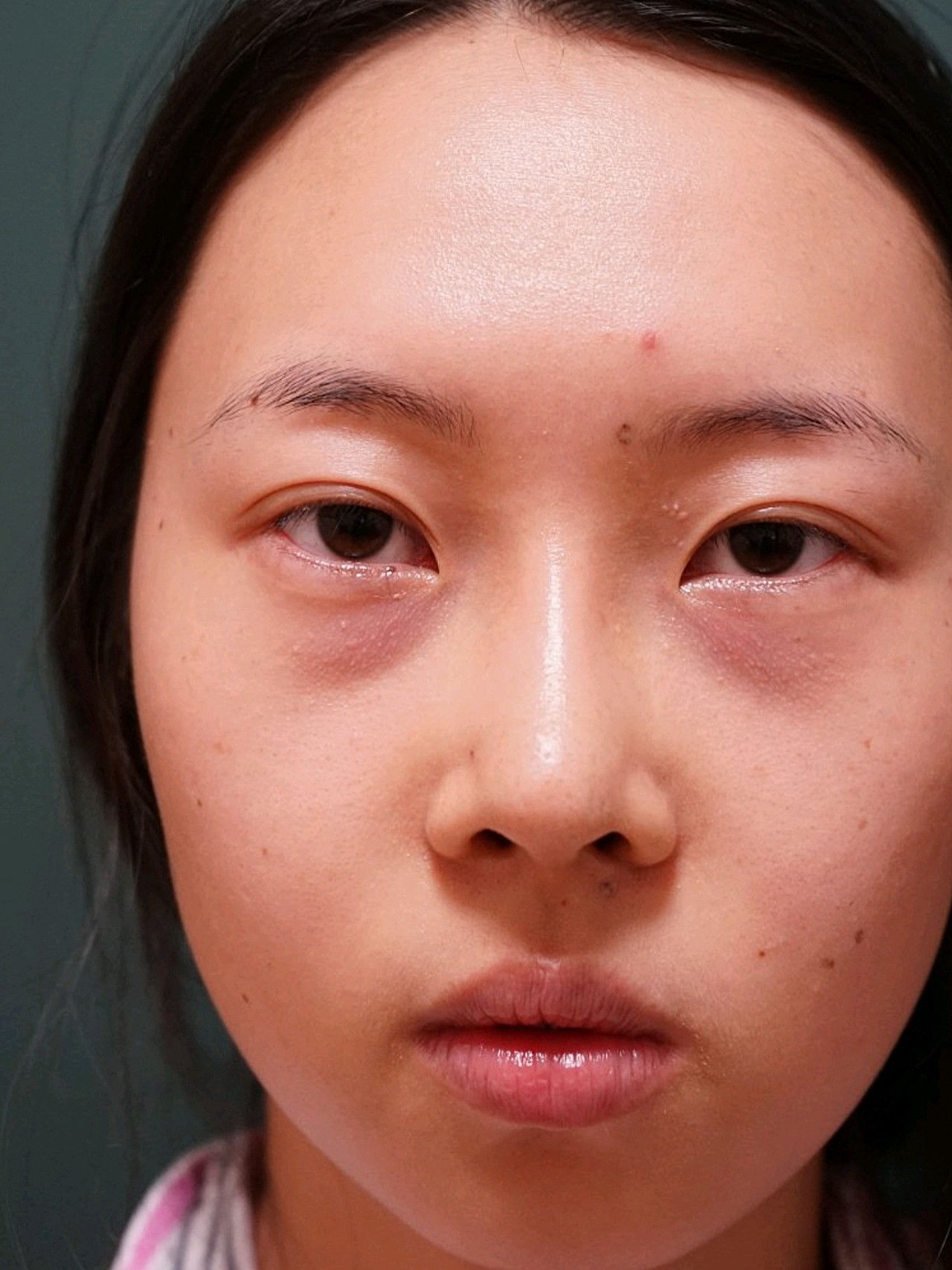 眼部修复 内吸祛眼袋