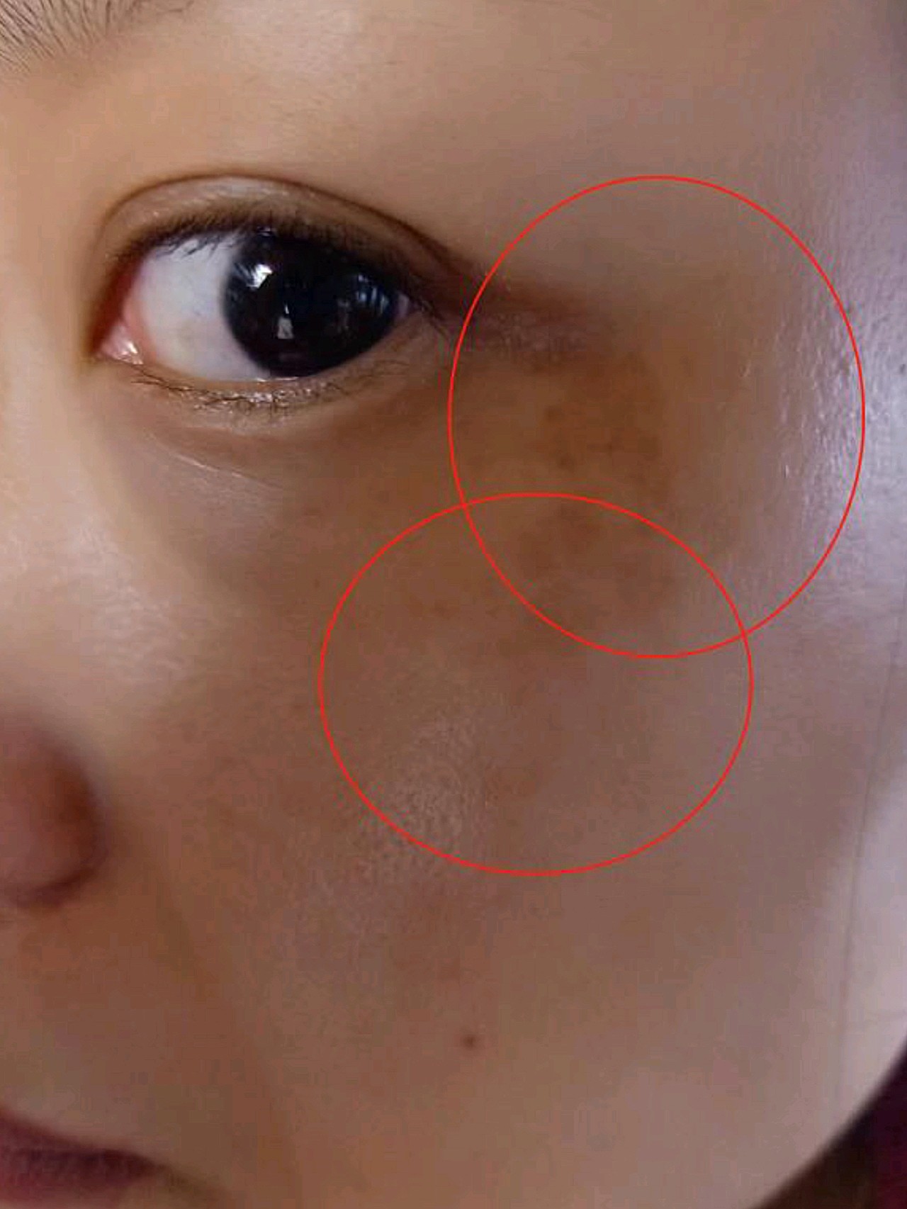 皮秒之后斑点部位反黑,现在还没褪去.