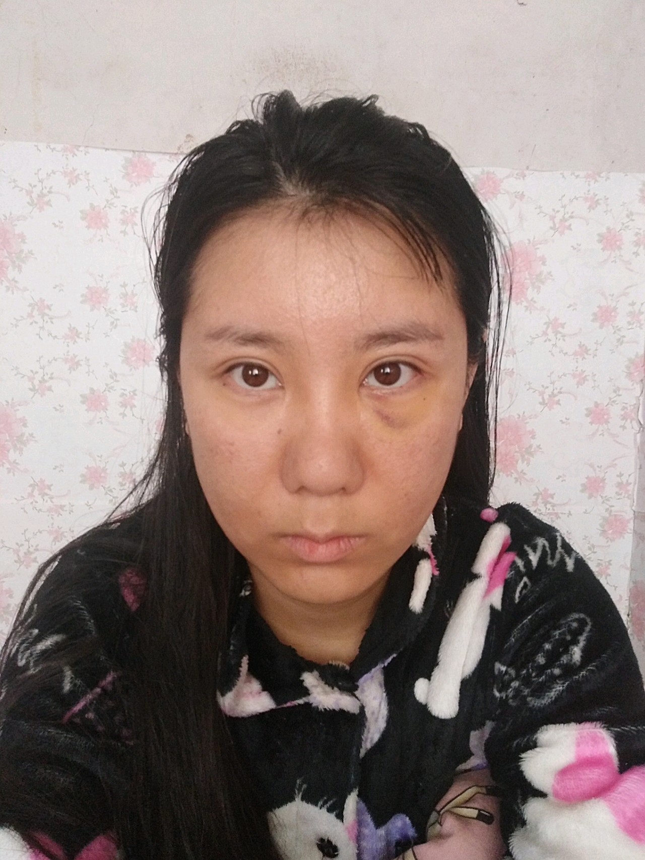 内路眼袋取出脂肪硬块第四天,最后一是最早有泪沟的照_圈子-新氧美容