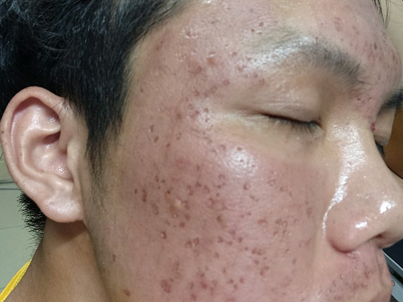 这痘坑密密麻麻的,可能有上百个吧,还在恢复期,希