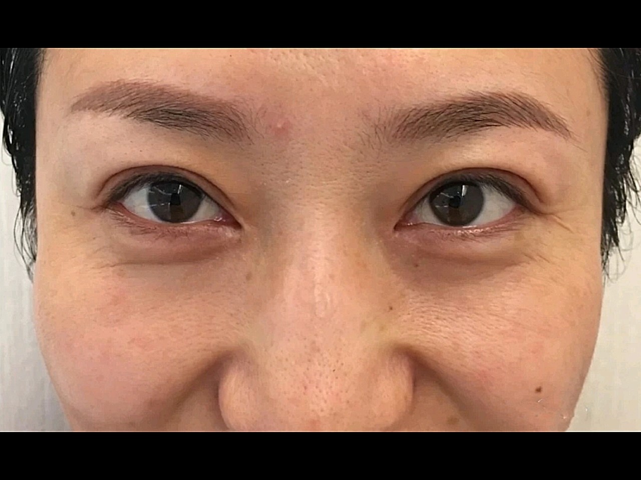 嗨体注射眼周,泪沟和黑眼圈看起来好了很多,干纹细纹_圈子-新氧美容整