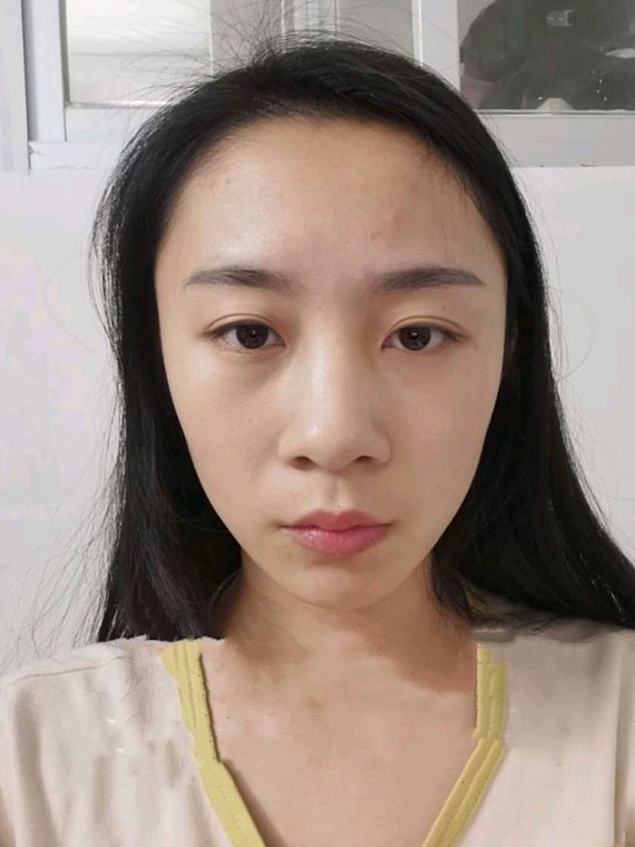 9999求美者从小就觉得自己短鼻子不好看,小时候只觉得_圈子-新氧