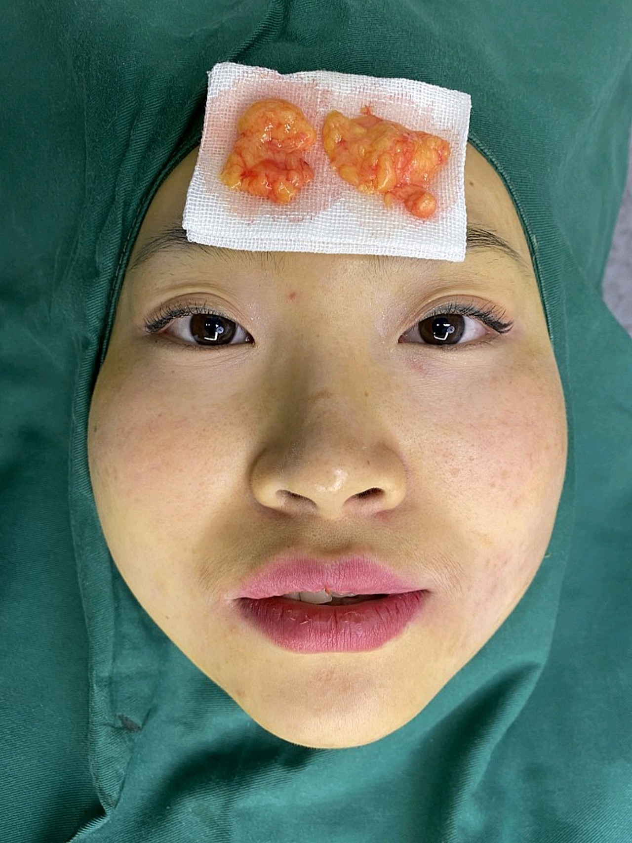 【取颊脂垫瘦脸术后1天】手术结束啦,我闺蜜在外面等_圈子-新氧美容