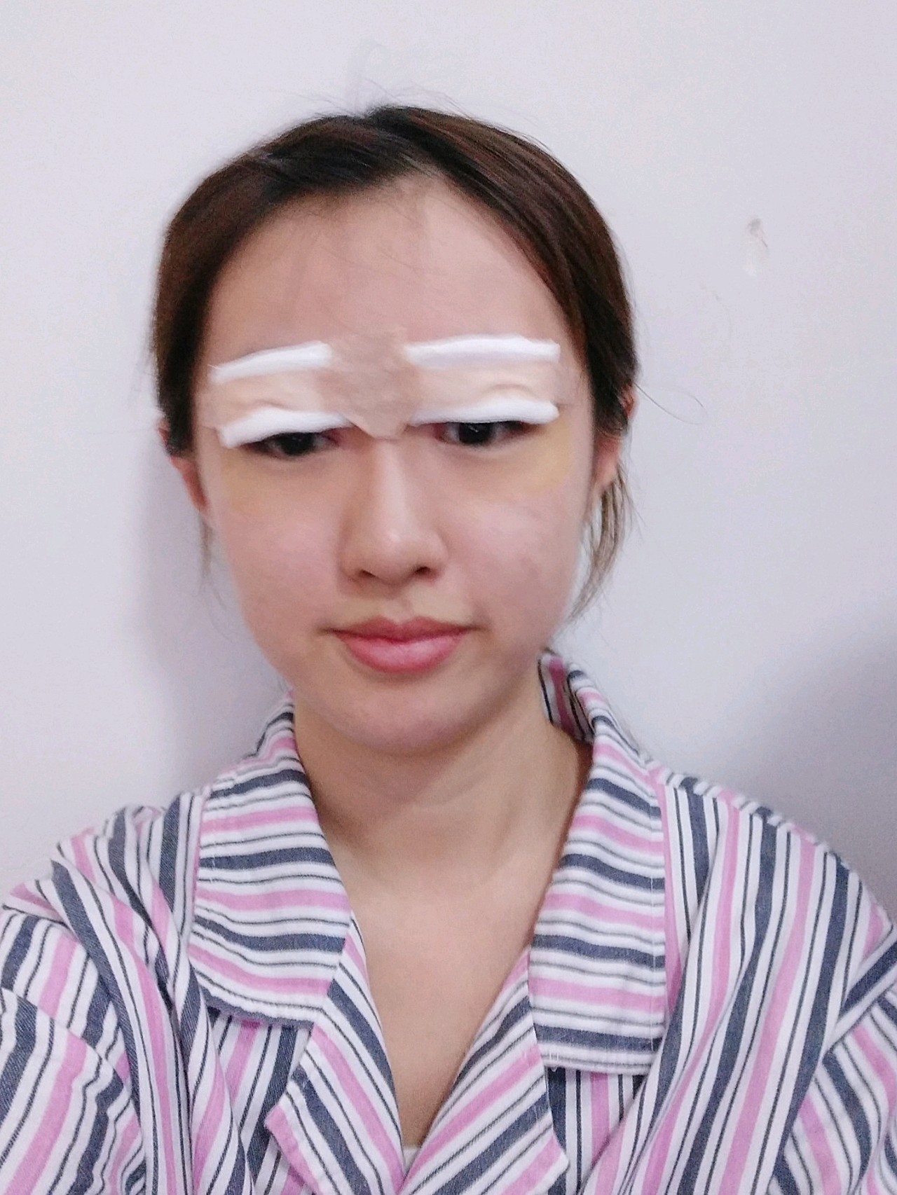 【罗氏双眼皮多项手术第一天】其实我一直都是一个比较_圈子-新氧美容