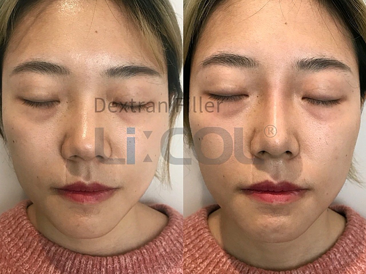 韩国licol葡聚糖生物肋骨鼻