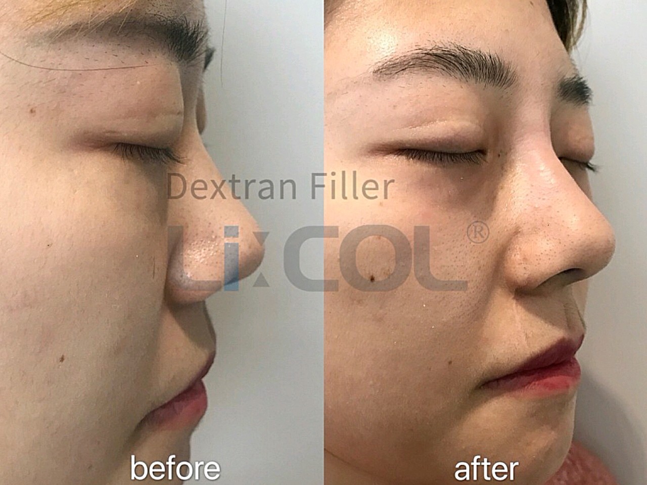 韩国licol葡聚糖生物肋骨鼻