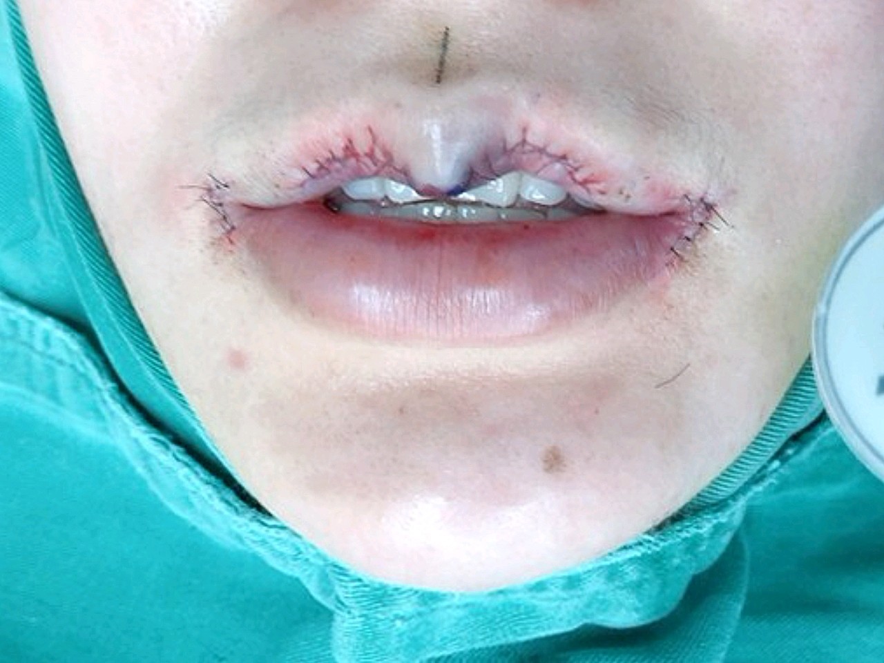 【唇部综合】【m唇综合】 花瓣唇/微笑m唇/轻启微笑厚唇改薄m唇嘴角