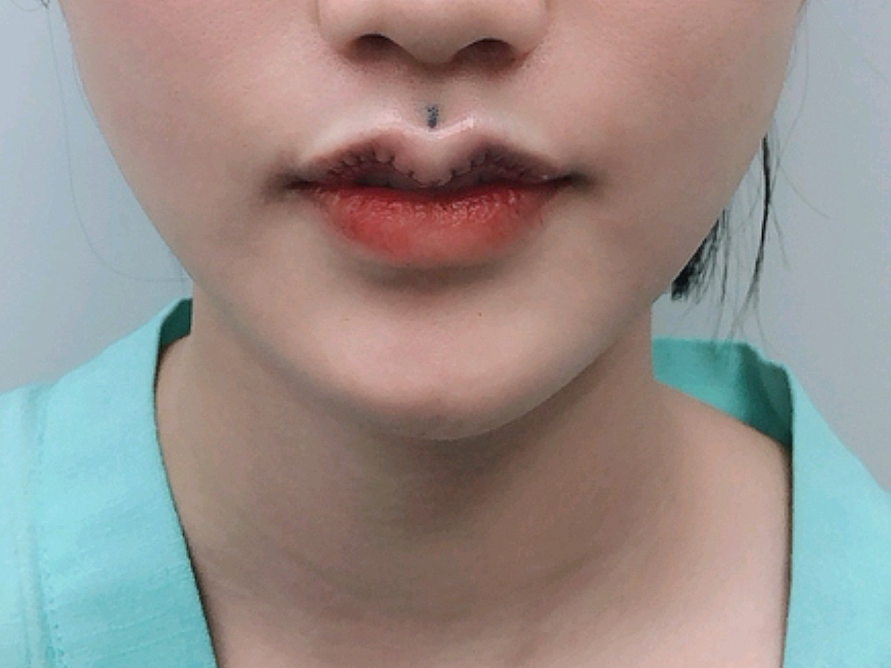 【唇部综合】【m唇综合】 花瓣唇/微笑m唇/轻启微笑厚唇改薄m唇嘴角