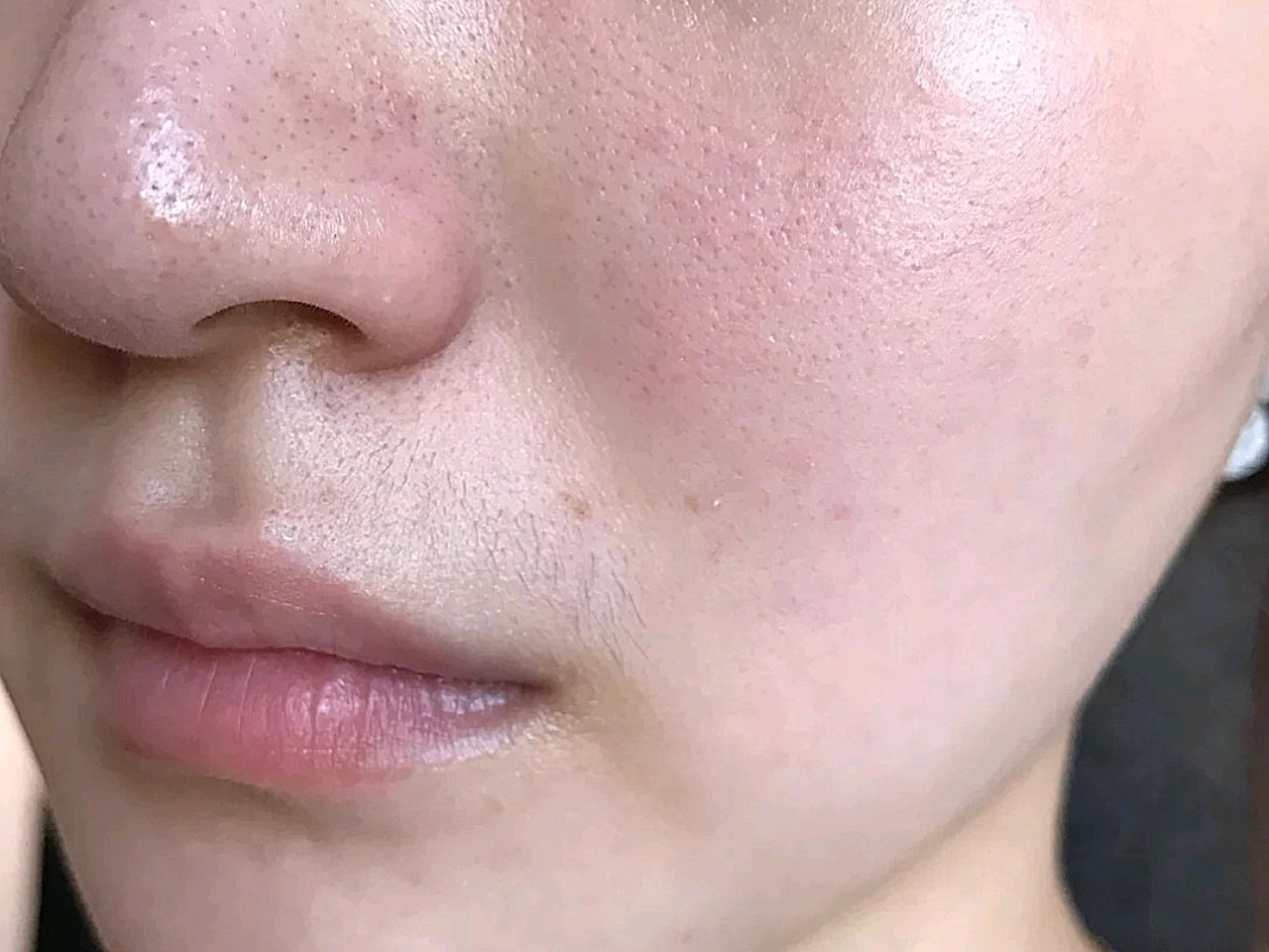 光子嫩肤的效果还是挺好的,我之前肤色有点不均匀还有_圈子-新氧美容