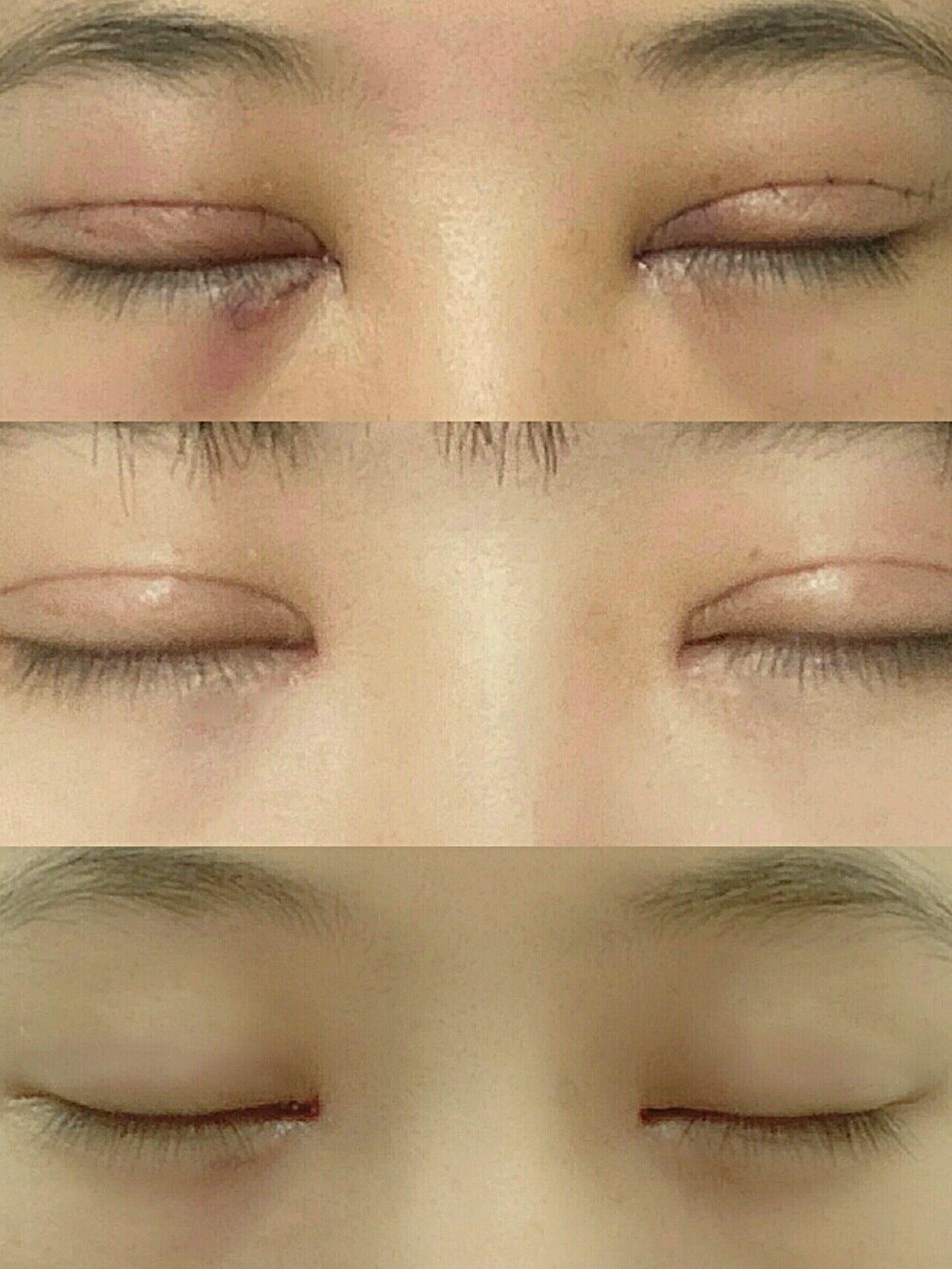 虽然我单眼皮也好看哈哈哈,但是我还是忍不住割了双眼_圈子-新氧美容