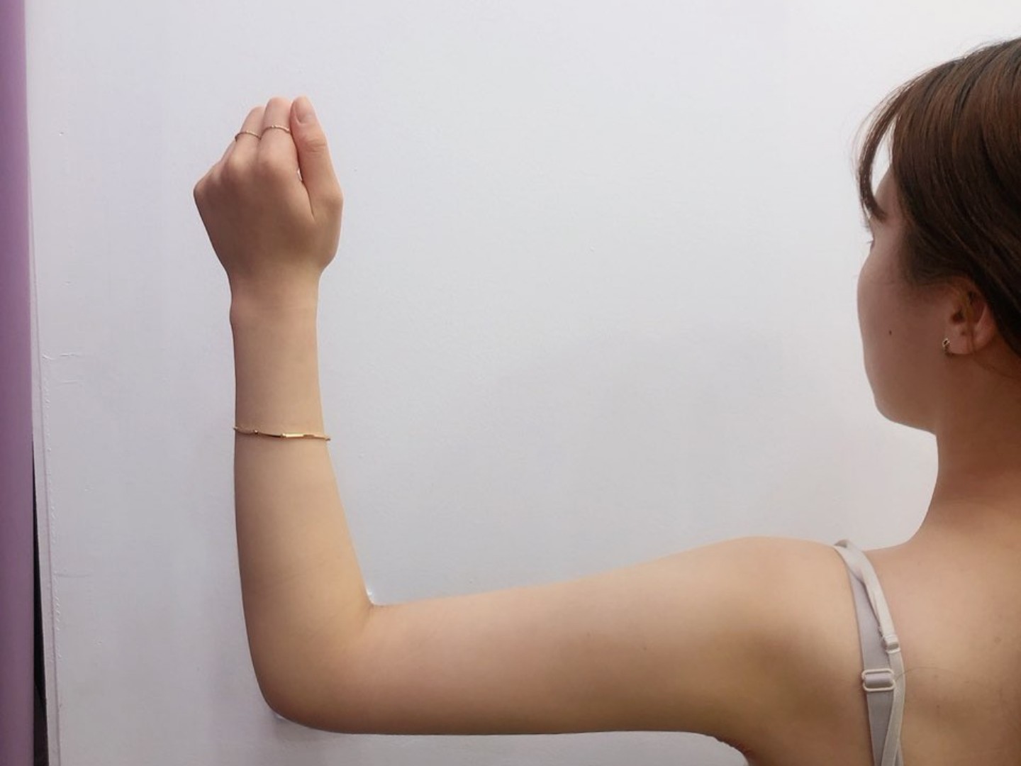 手臂吸脂后一个月