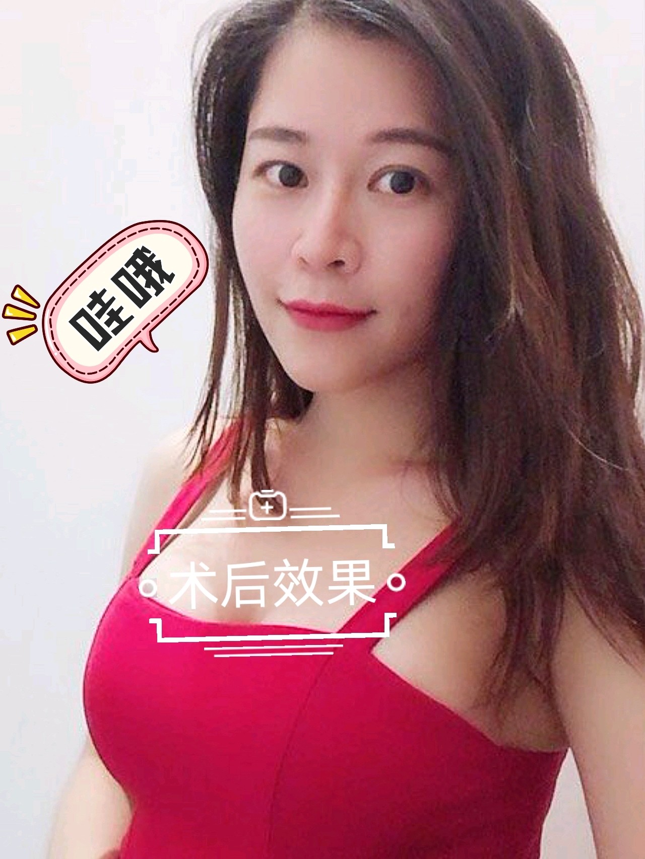 96术前状况:乳房皮肤松弛,脂肪流失,呈轻微下垂状,_圈子-新氧美容