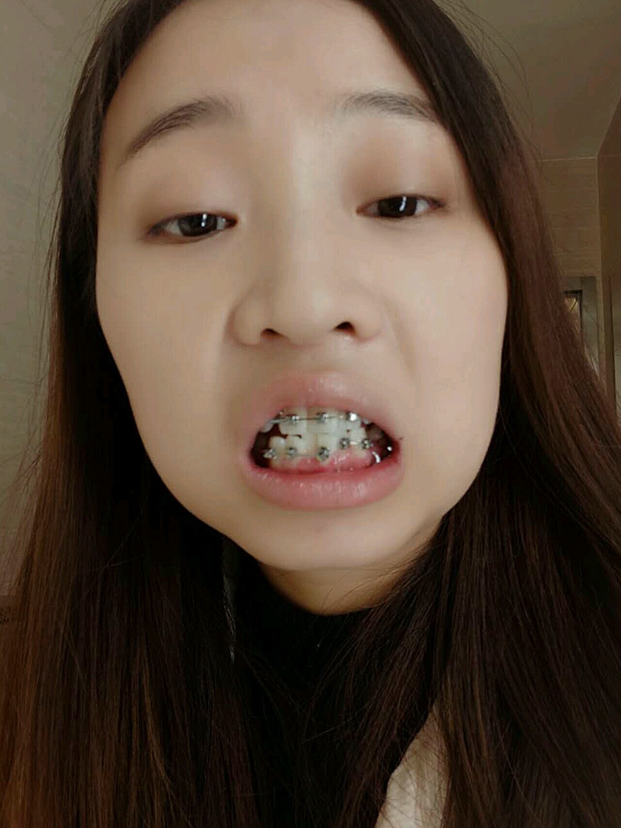 戴牙套三个月了,这次终于把下牙套也粘上了,没想到粘_圈子-新氧美容