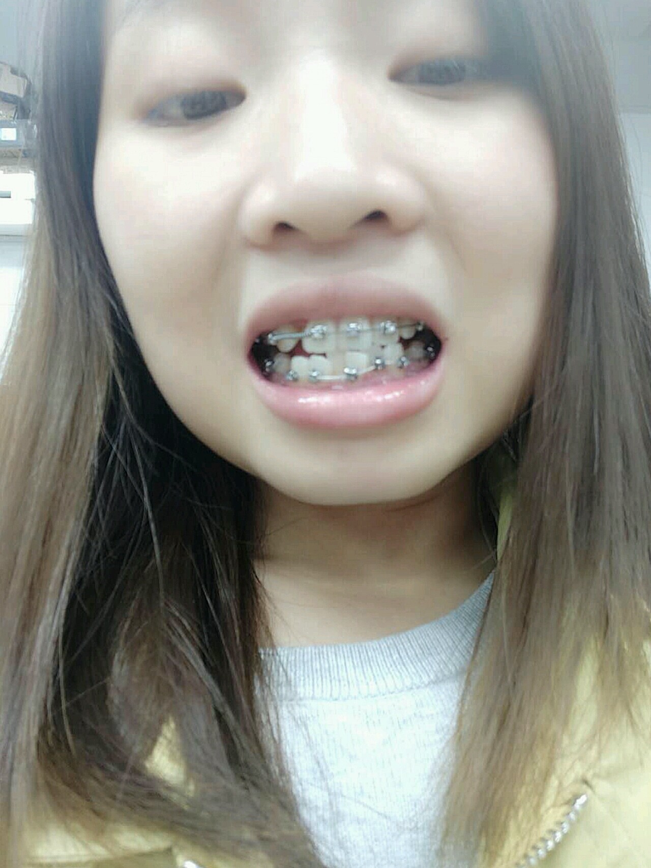 戴牙套三个月了,这次终于把下牙套也粘上了,没想到粘_圈子-新氧美容