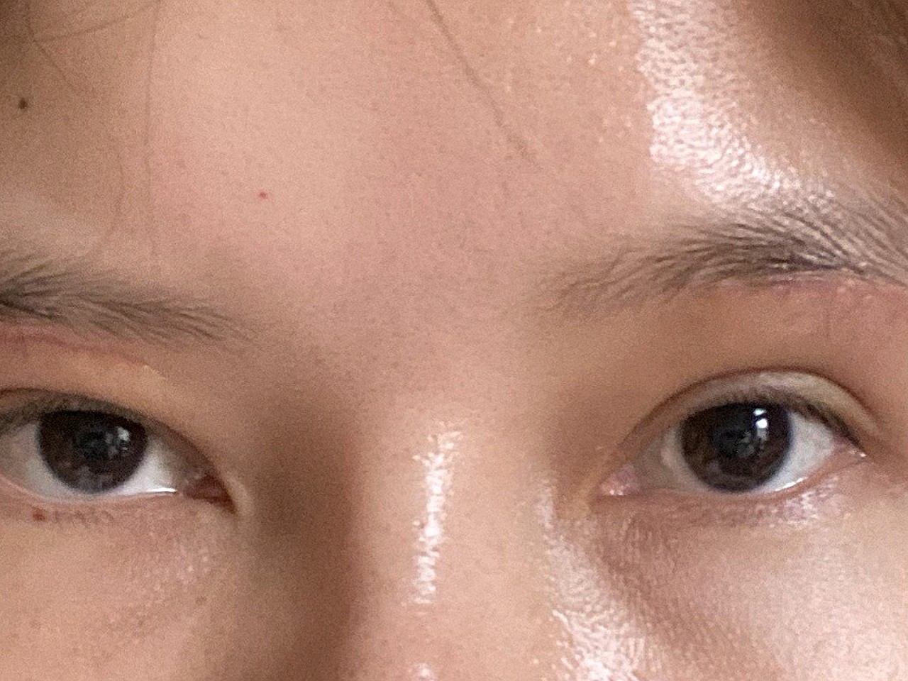 在美莱做的提眉术失败了