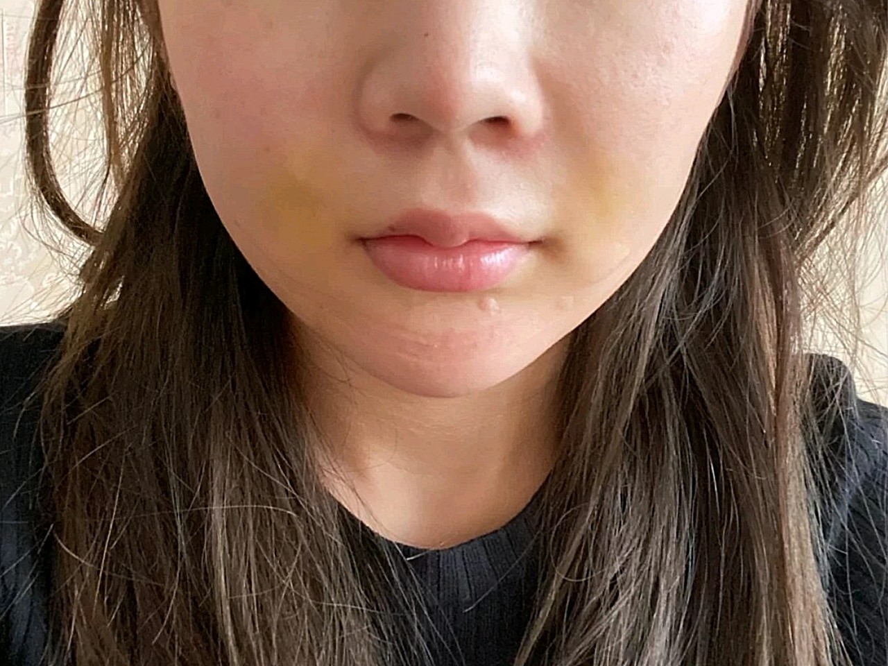 【沈阳汇美人面部黄金微雕术后第5天】