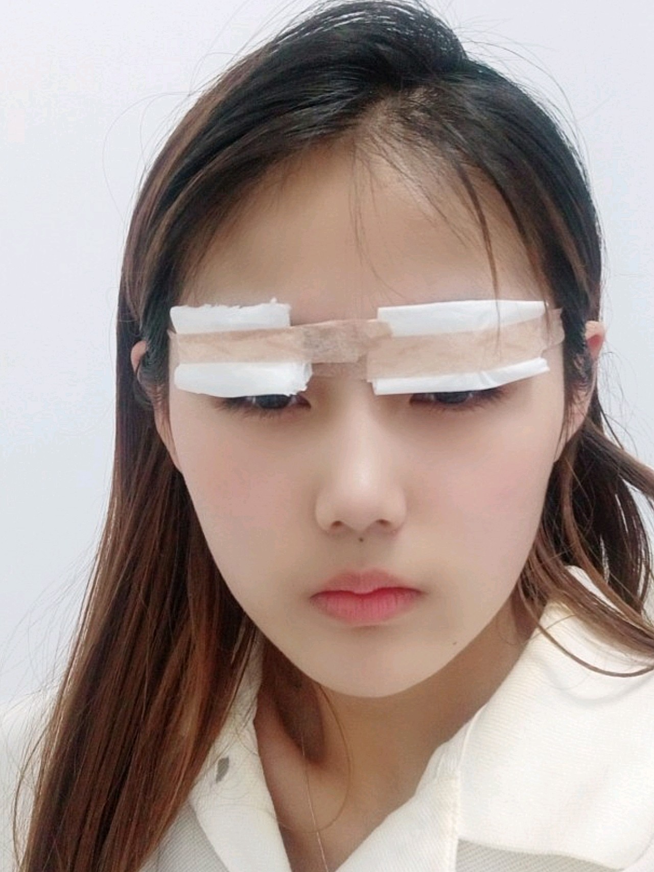 【眼部多项术后5天】因为我每天都要换纱布,所以前天回_圈子-新氧美容