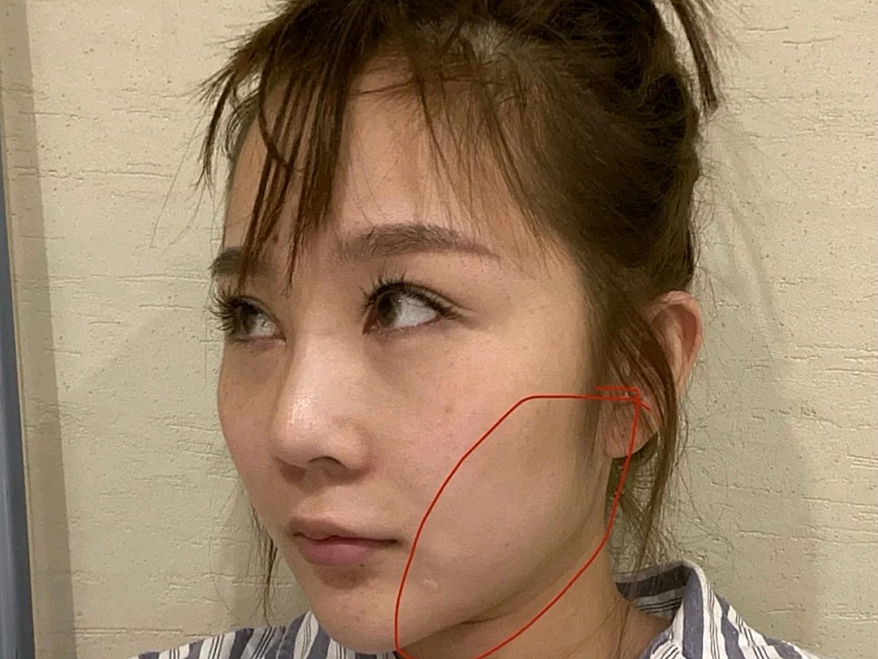 【沈阳汇美人面部黄金微雕术后第1天】