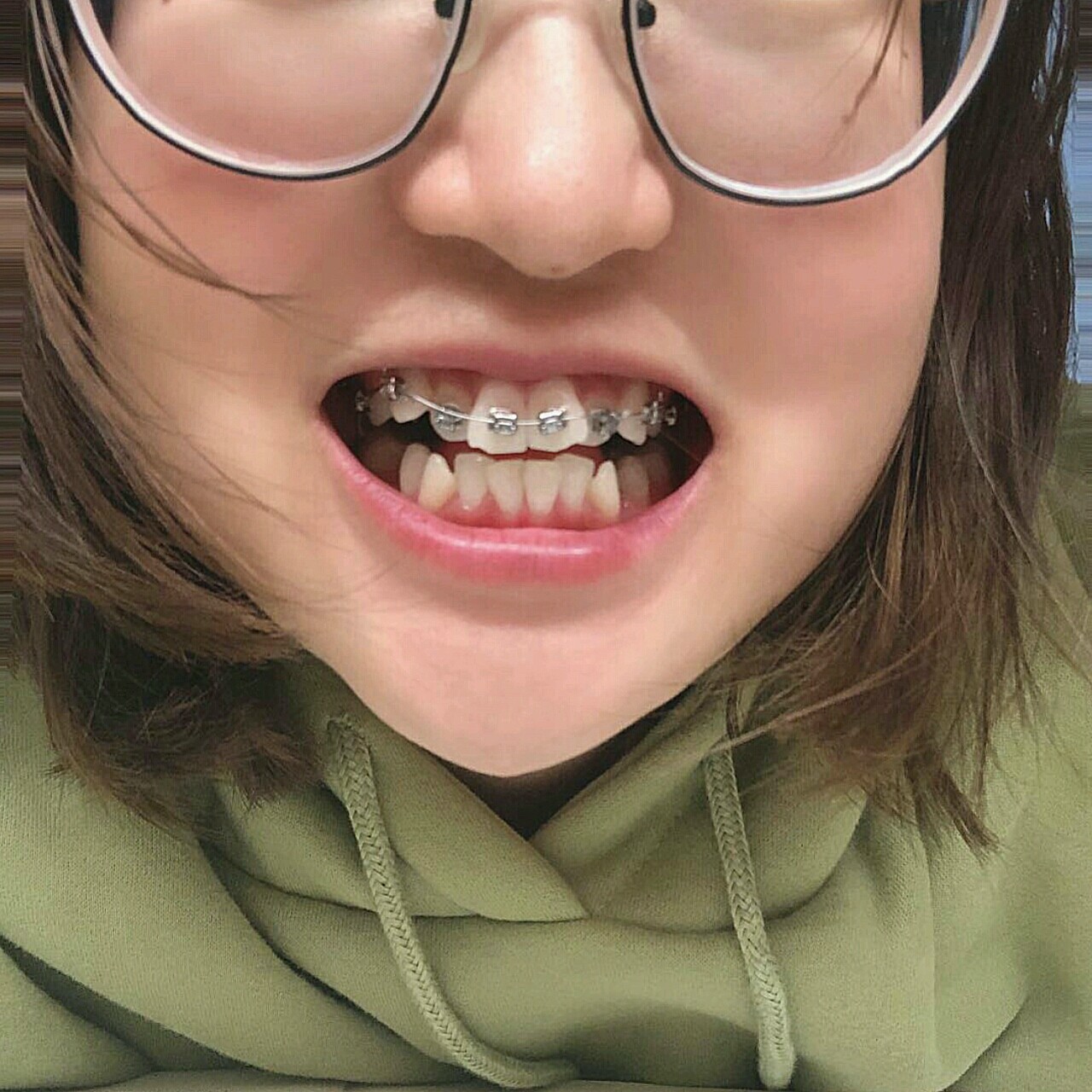 感受:9月16戴上了上牙套,刚带上感觉托槽和钢丝有_圈子-新氧美容整形