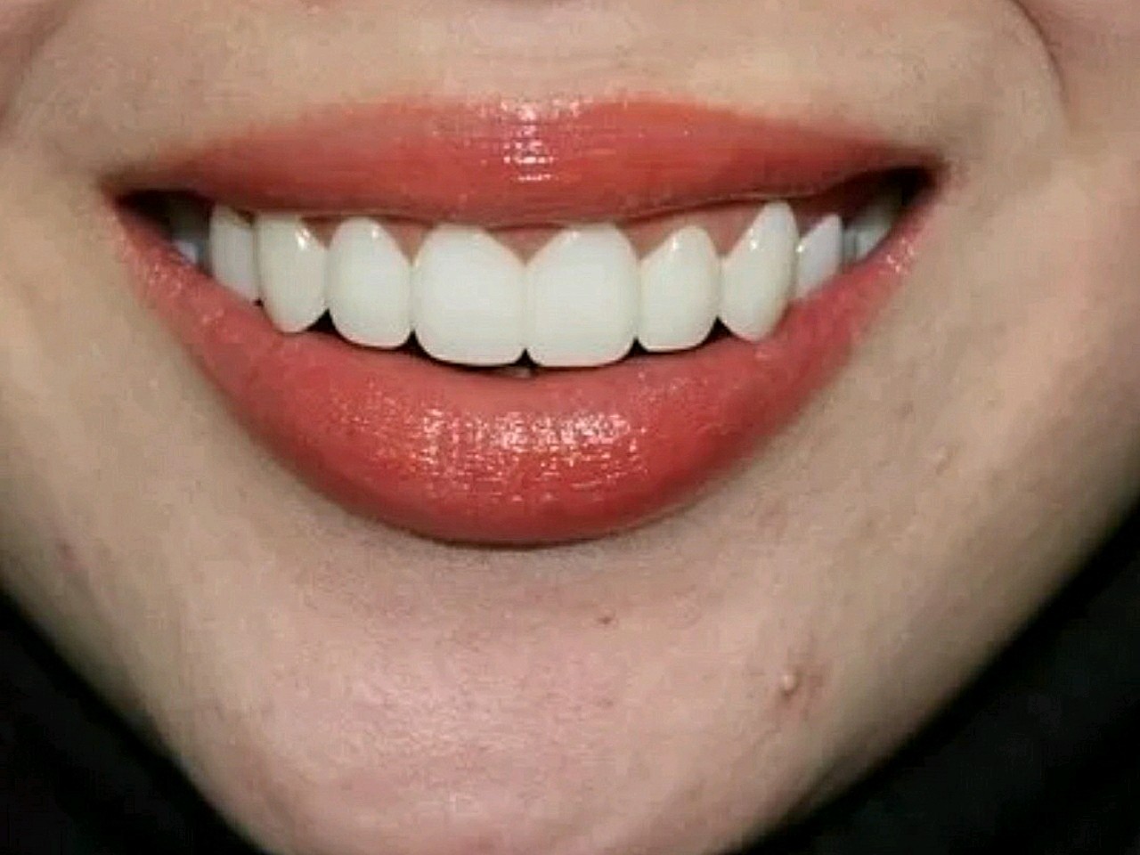 最后的效果让我震惊太喜欢正常牙齿正常牙齿图片漂亮的牙齿标准好看的