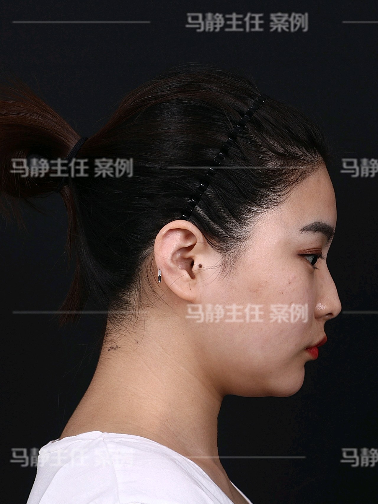 线雕双下巴吸脂术后7天