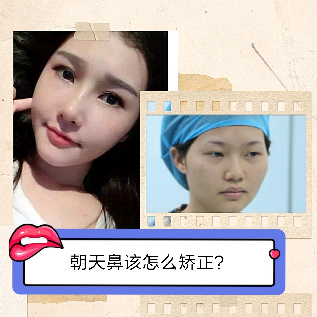 朝天鼻该怎么矫正?