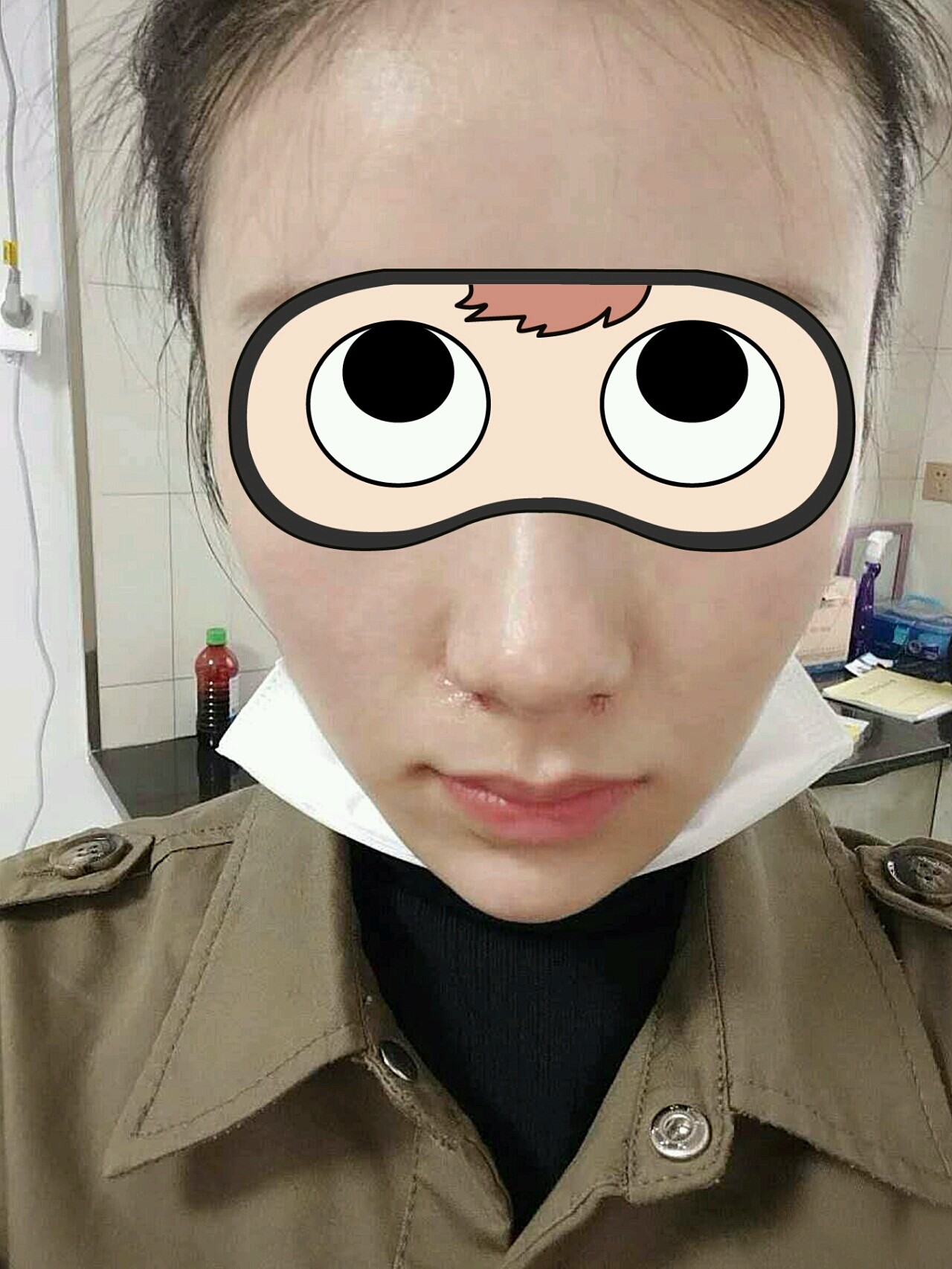 陈院长推荐我做了内切缩鼻翼,给大家看看效果,疼痛嘛_圈子-新氧美容