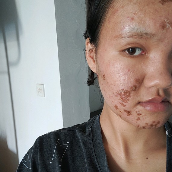 第五天有点反黑【果酸焕肤】【果酸焕肤】淡斑祛黑,医_圈子-新氧美容