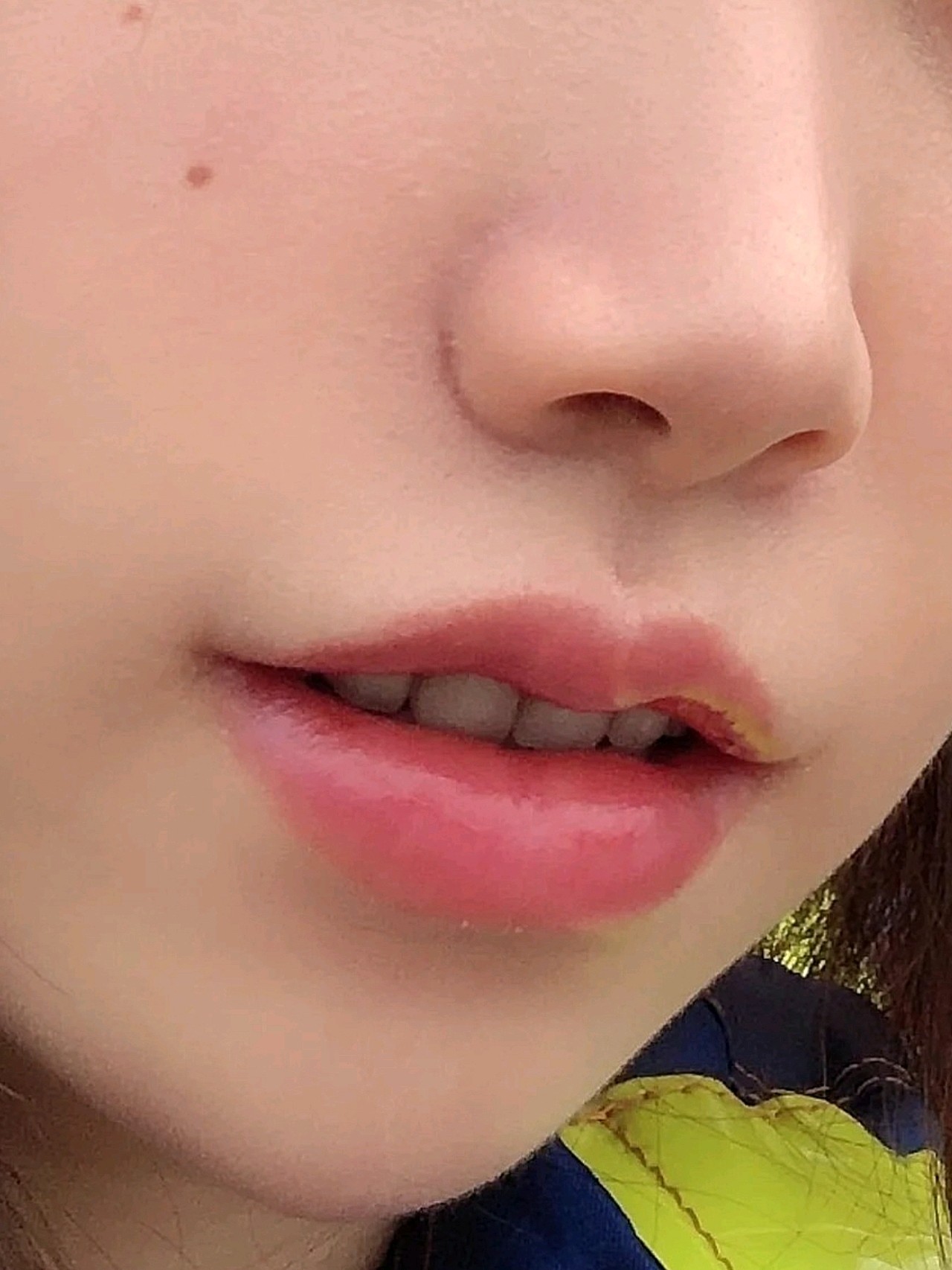 上唇比较厚,就想做成那种baby唇,面诊后就给医生_圈子-新氧美容整形