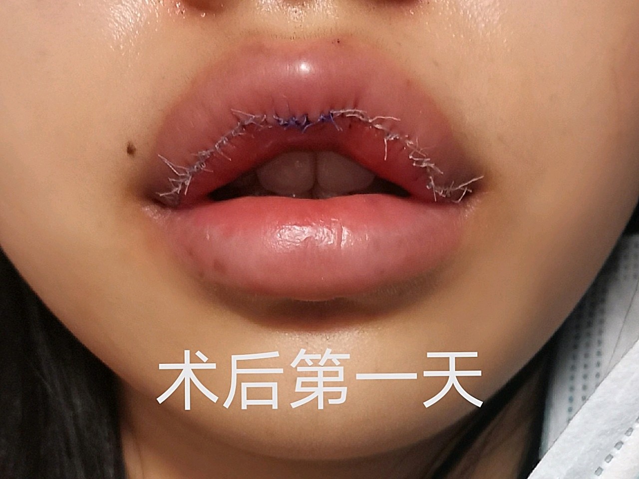 又来更新啦,术后消肿的全过程