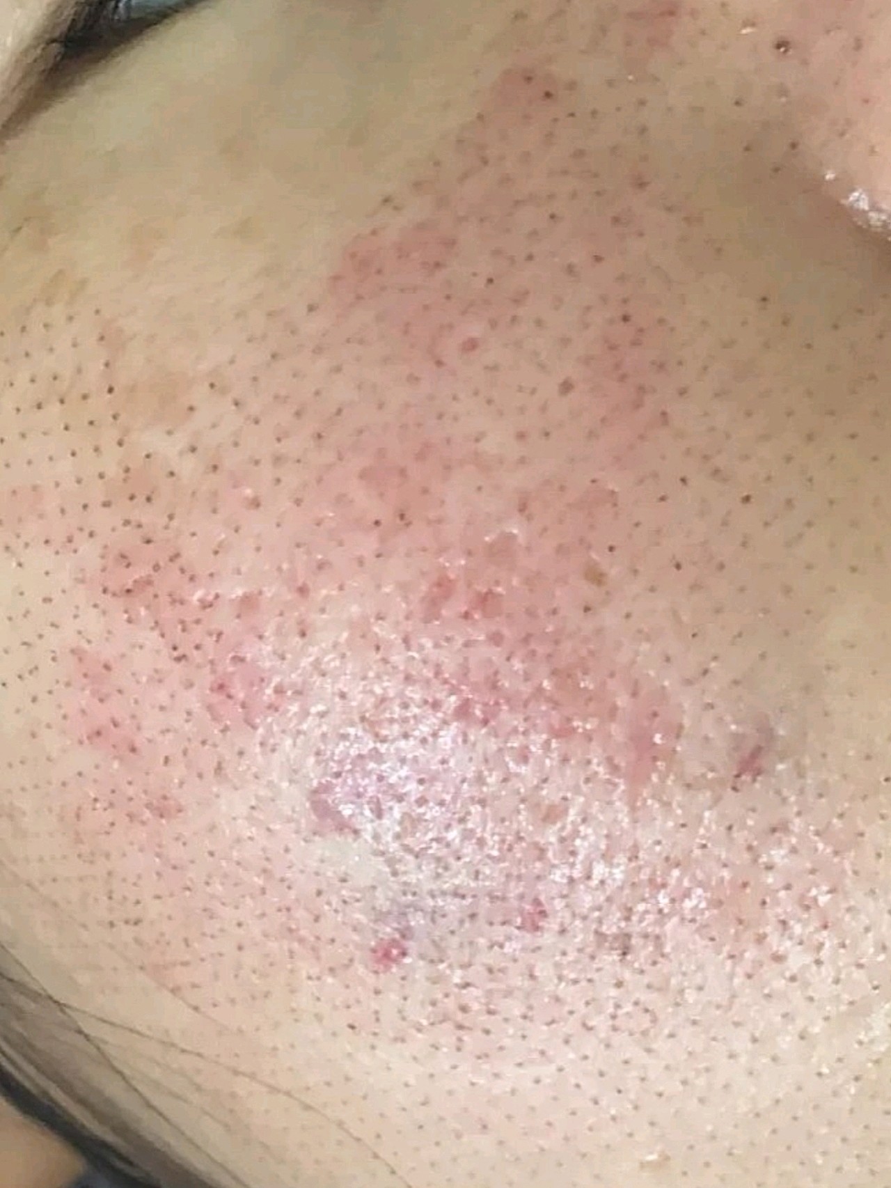 【点阵激光】二氧化碳点阵激光 祛痘印痘坑/改善毛孔粗大/淡化疤痕