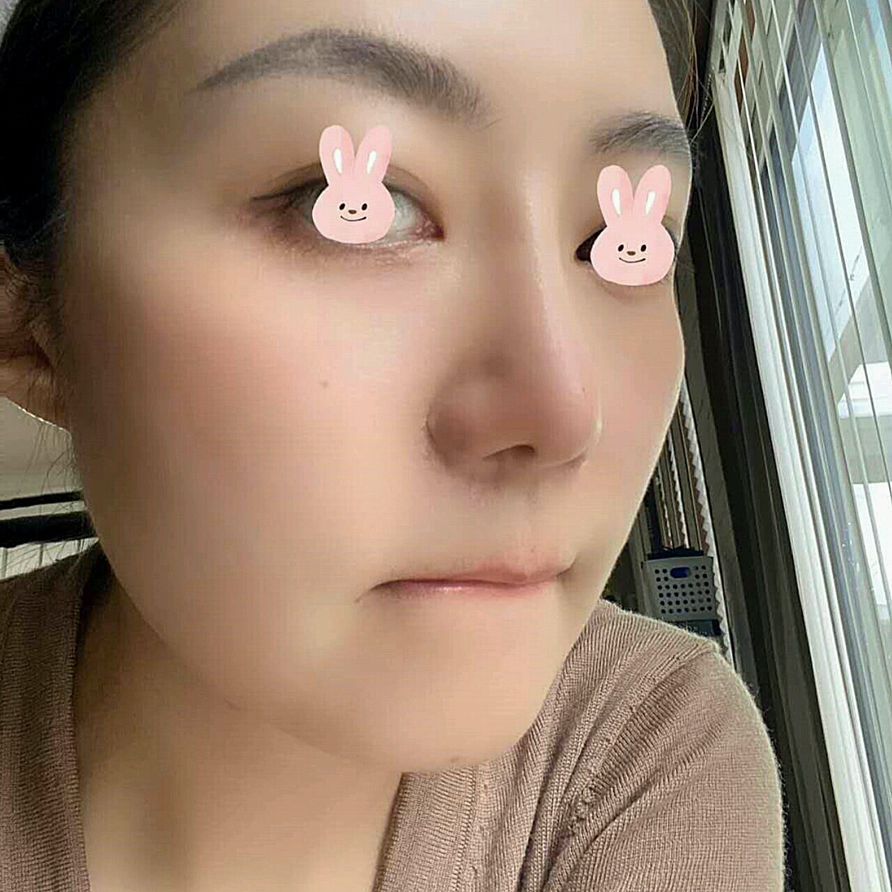 我是鼻翼大一直是我的烦恼,对比了很多家,说了我自己_圈子-新氧美容