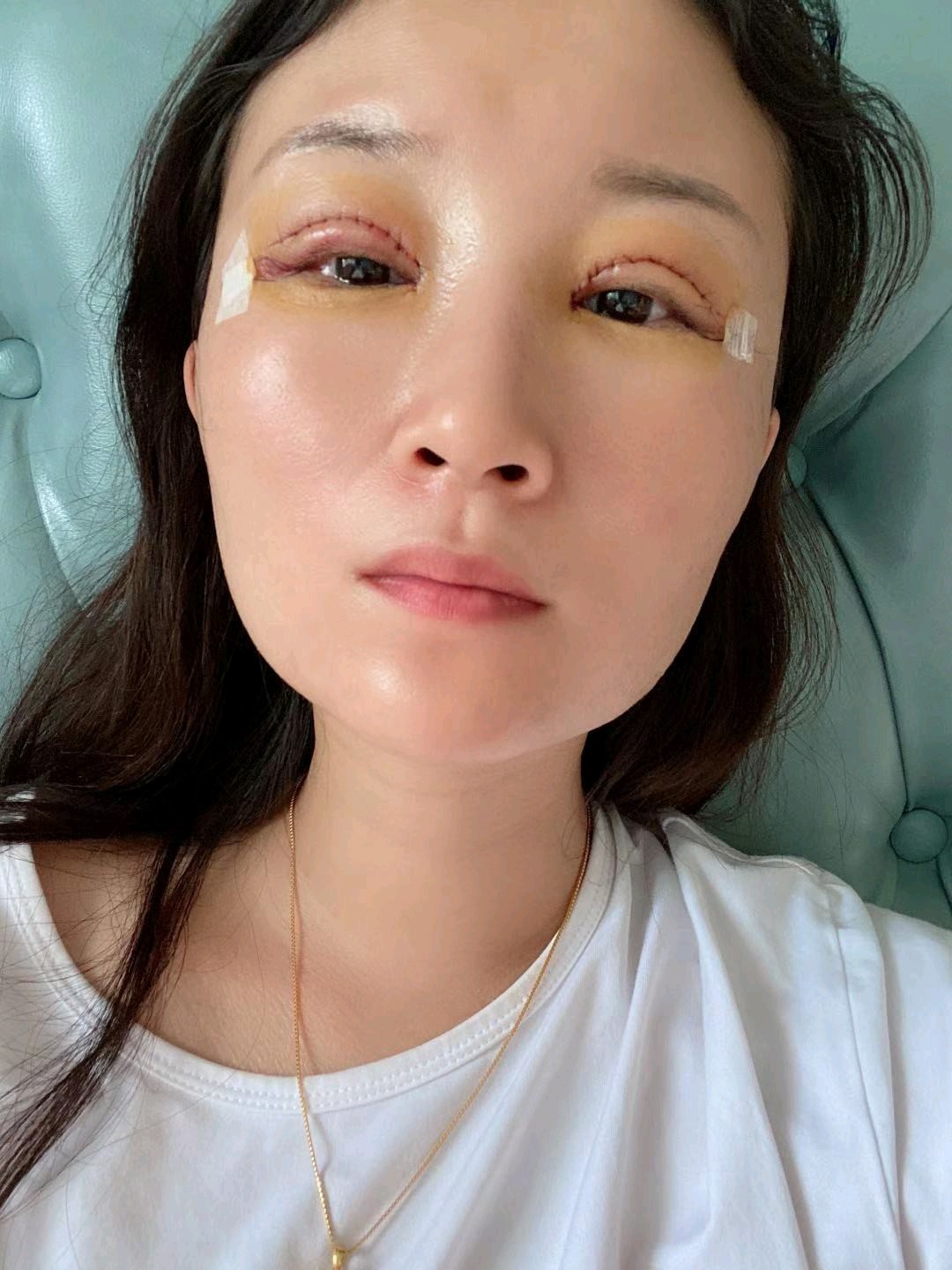 [重庆艺星 切开双眼皮 第2天]