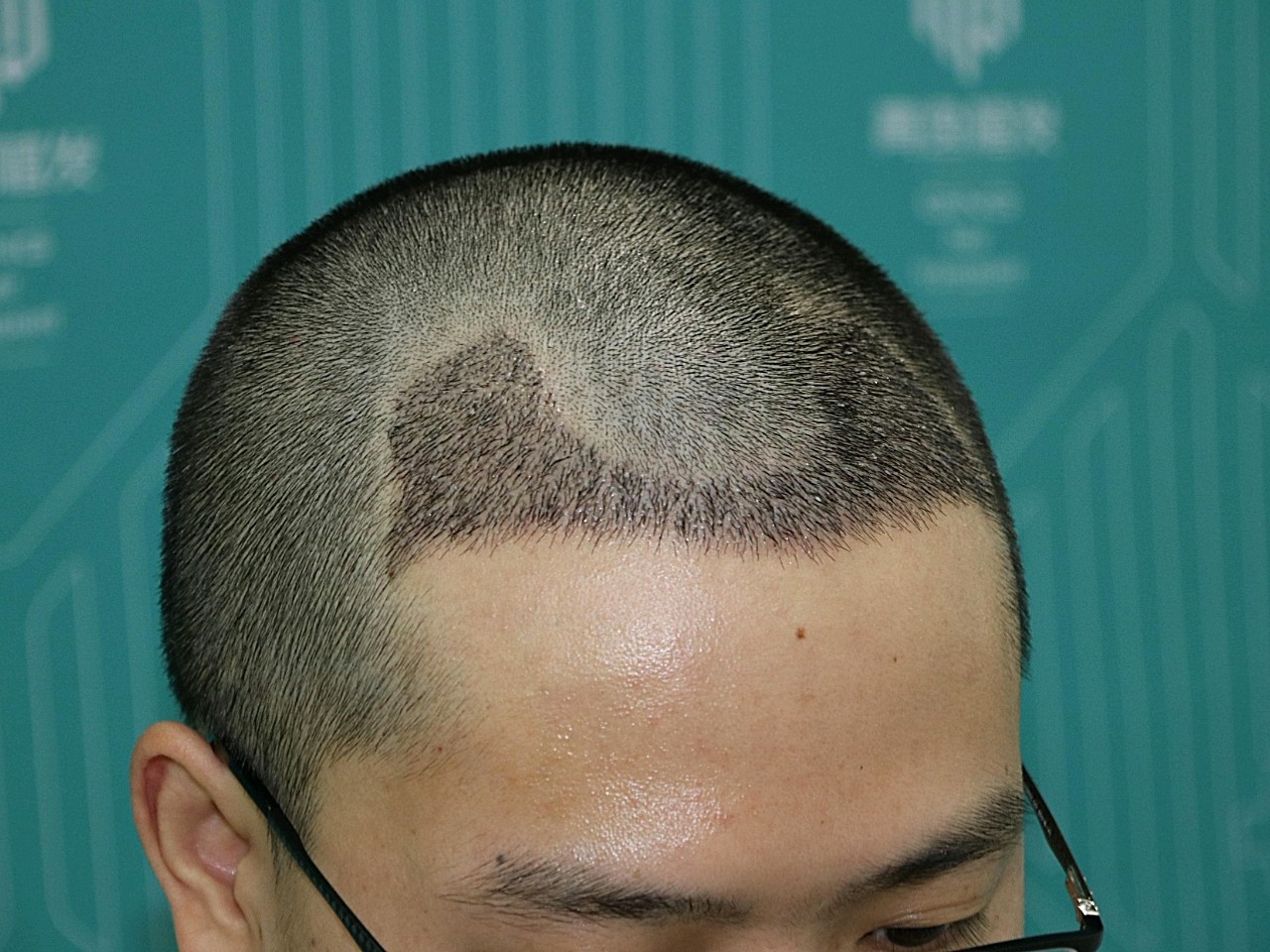 【植发记录】20天了