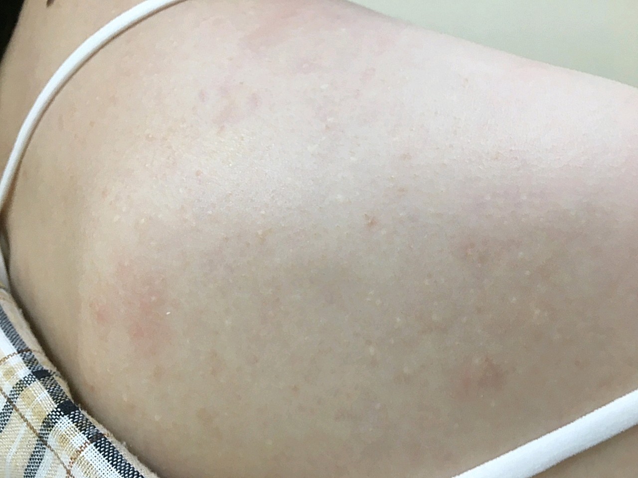 肩膀上的增生疙瘩,从记事起就有了,天气热的时候,汗_圈子-新氧美容