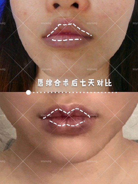 我的厚唇改薄变美进化史——第七天