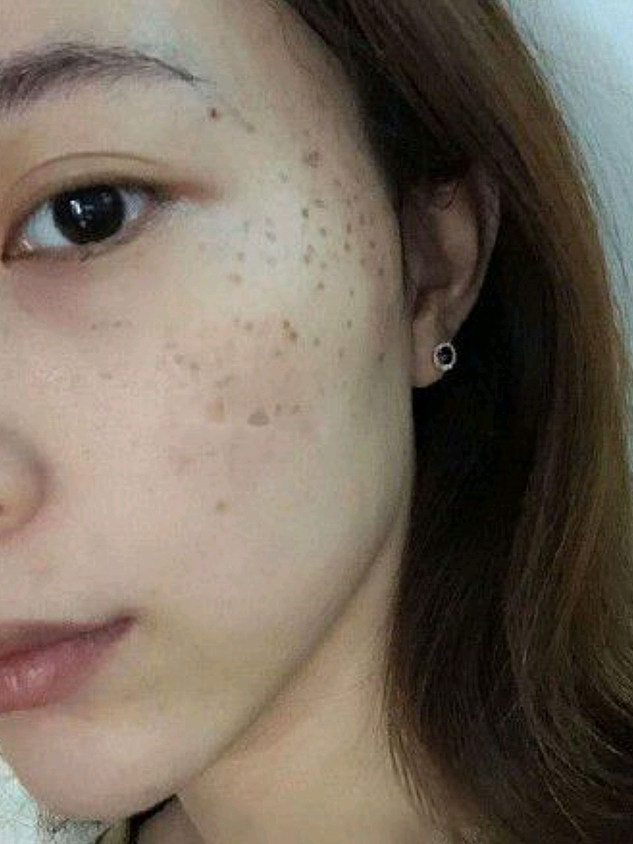 患者产后黄褐斑 颧部褐青色痣.