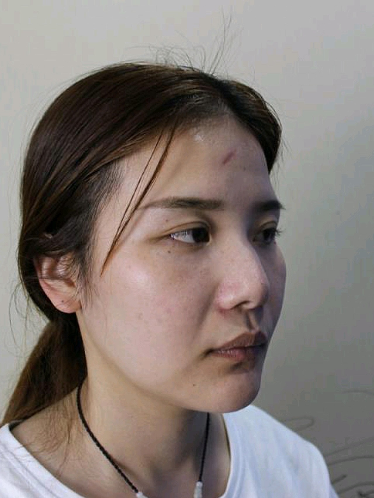 而一直受压下去了,最后做了手术…… 手术前 从侧面看驼峰鼻很严重吧