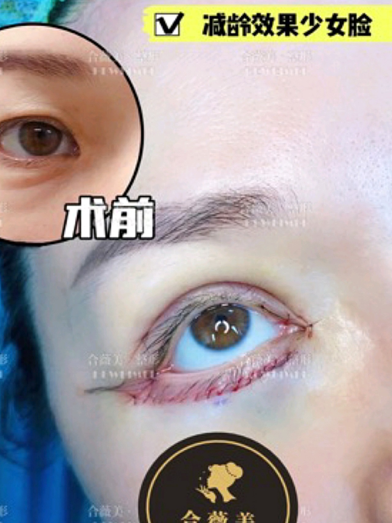 眼部多项77外切眼袋术后即刻对比78