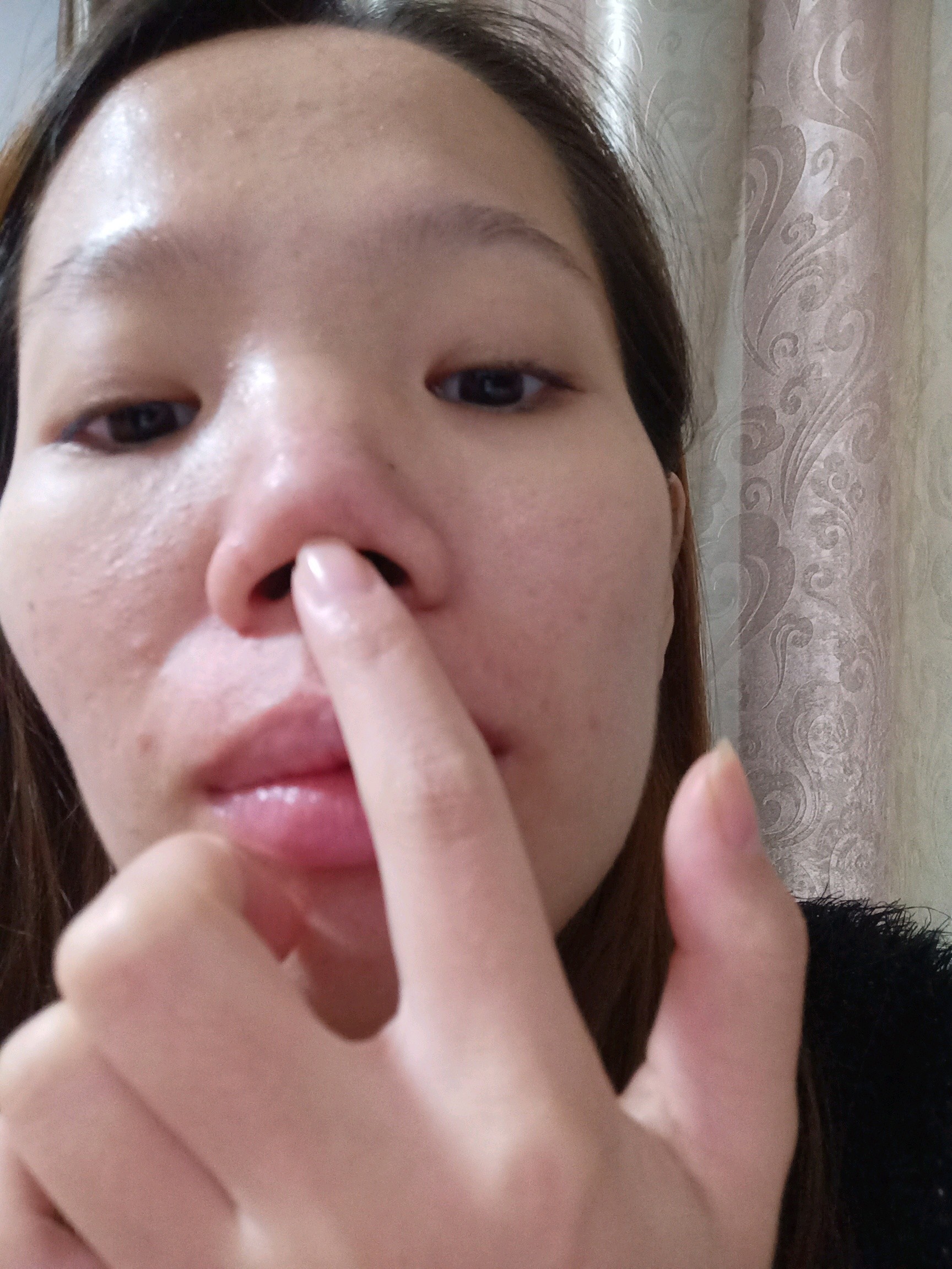 膨体加耳软骨取下后两年鼻尖还会红