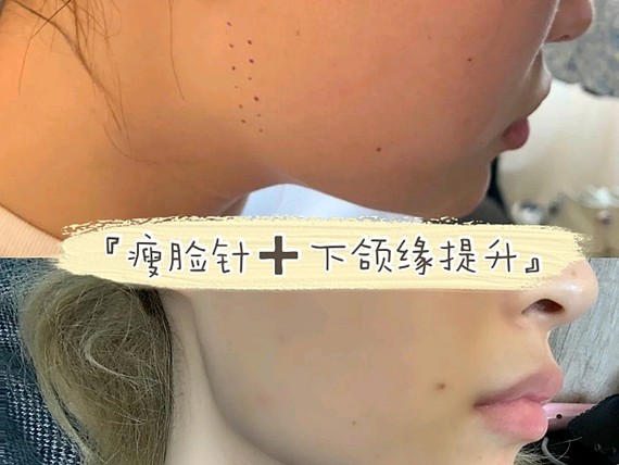 国产瘦脸针 下颌缘提升,效果真的很好