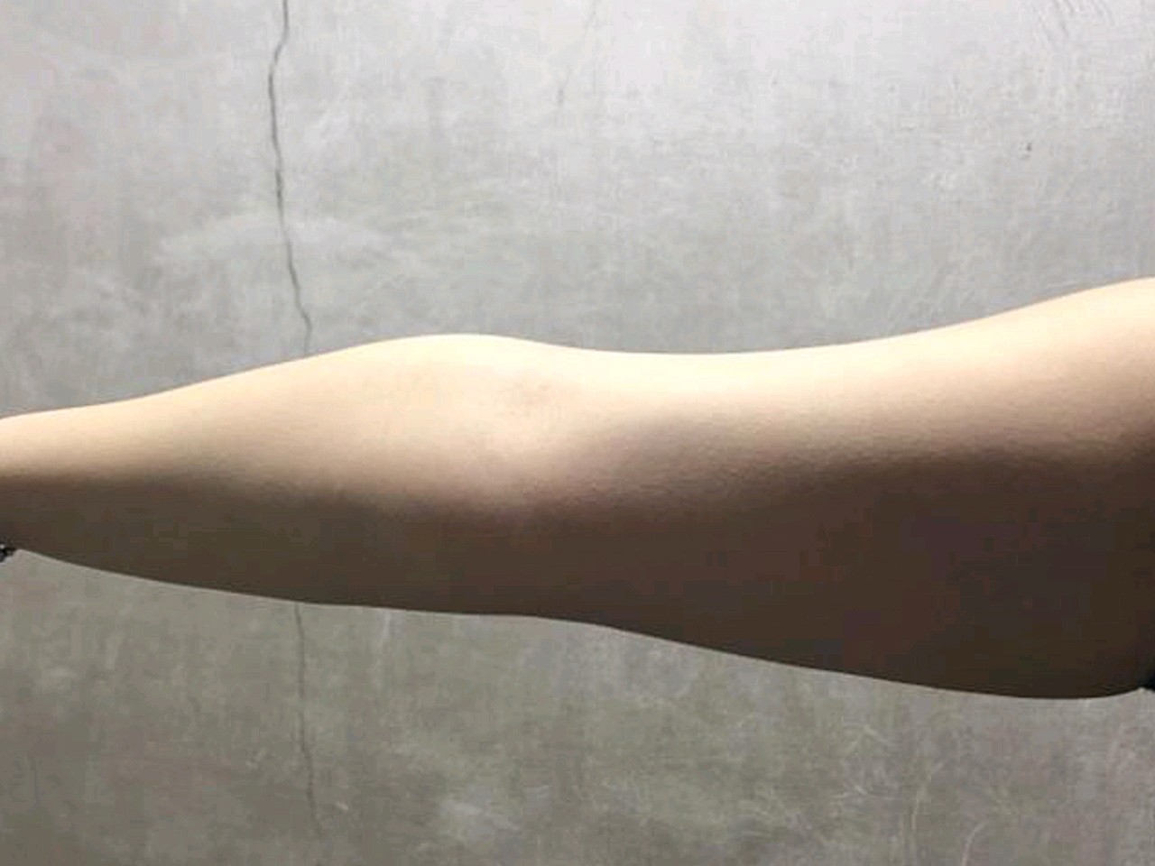 一次性做了双上臂 腰腹环吸,现在想想我还是伟大!