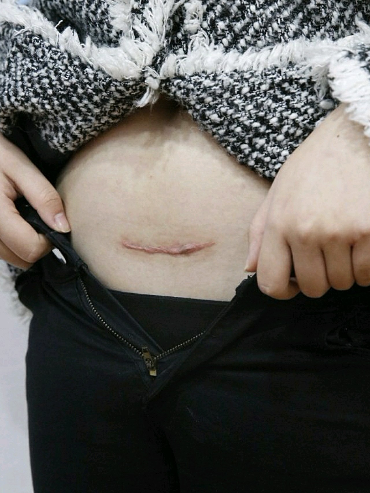 阑尾炎手术后疤痕位置图片