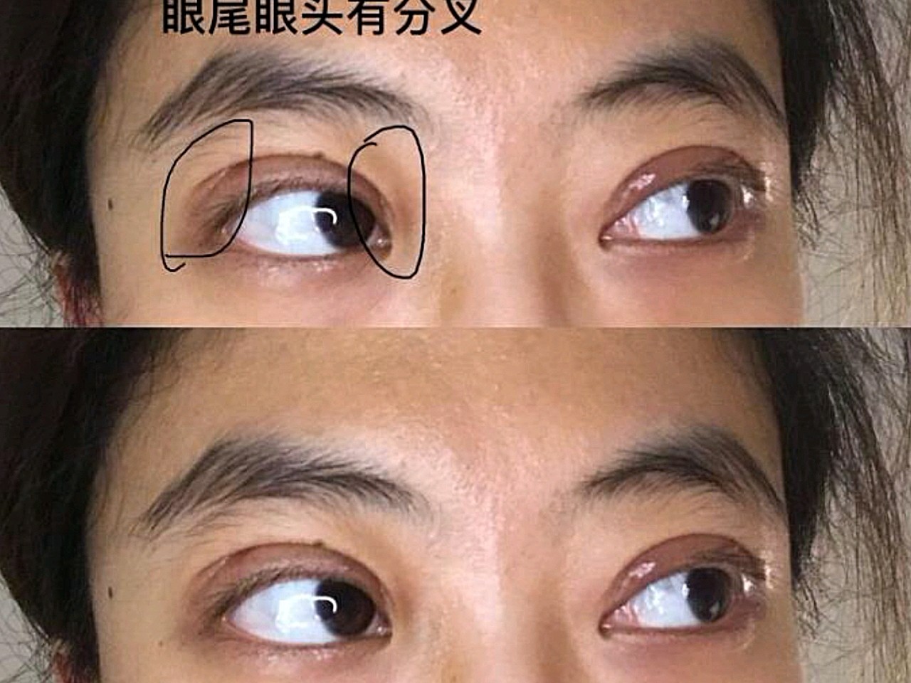做了全切双眼皮手术,眼头眼尾有分叉是怎么回事,会恢复吗?