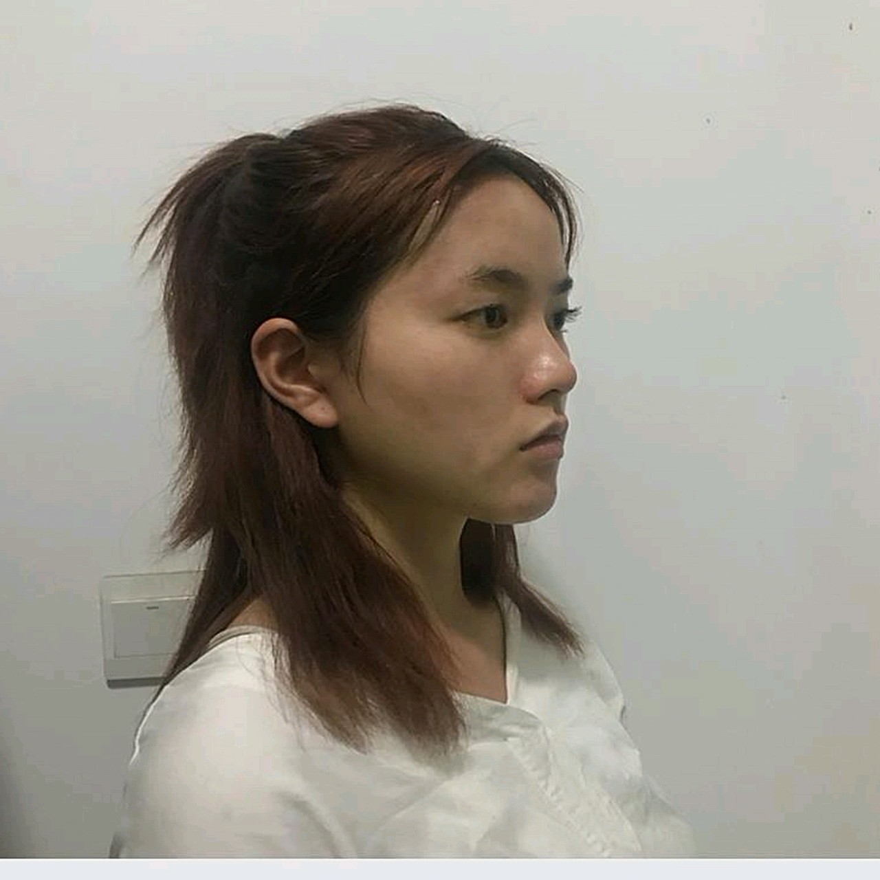 分享几张我手术前的正侧面照,然后就开始正题了.