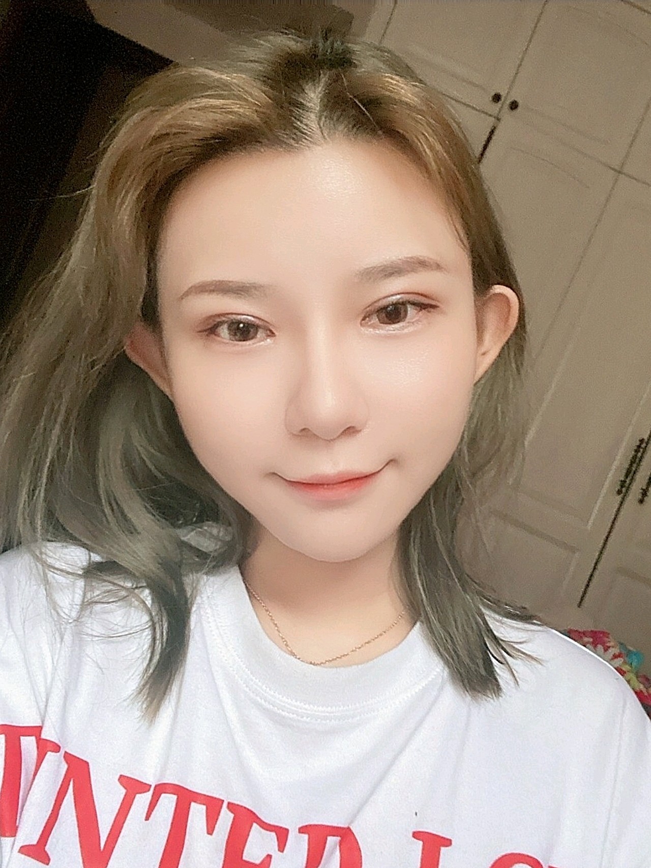 【雷氏精雕双眼皮修复术后30天】一个月啦眼角还是分_圈子-新氧美容