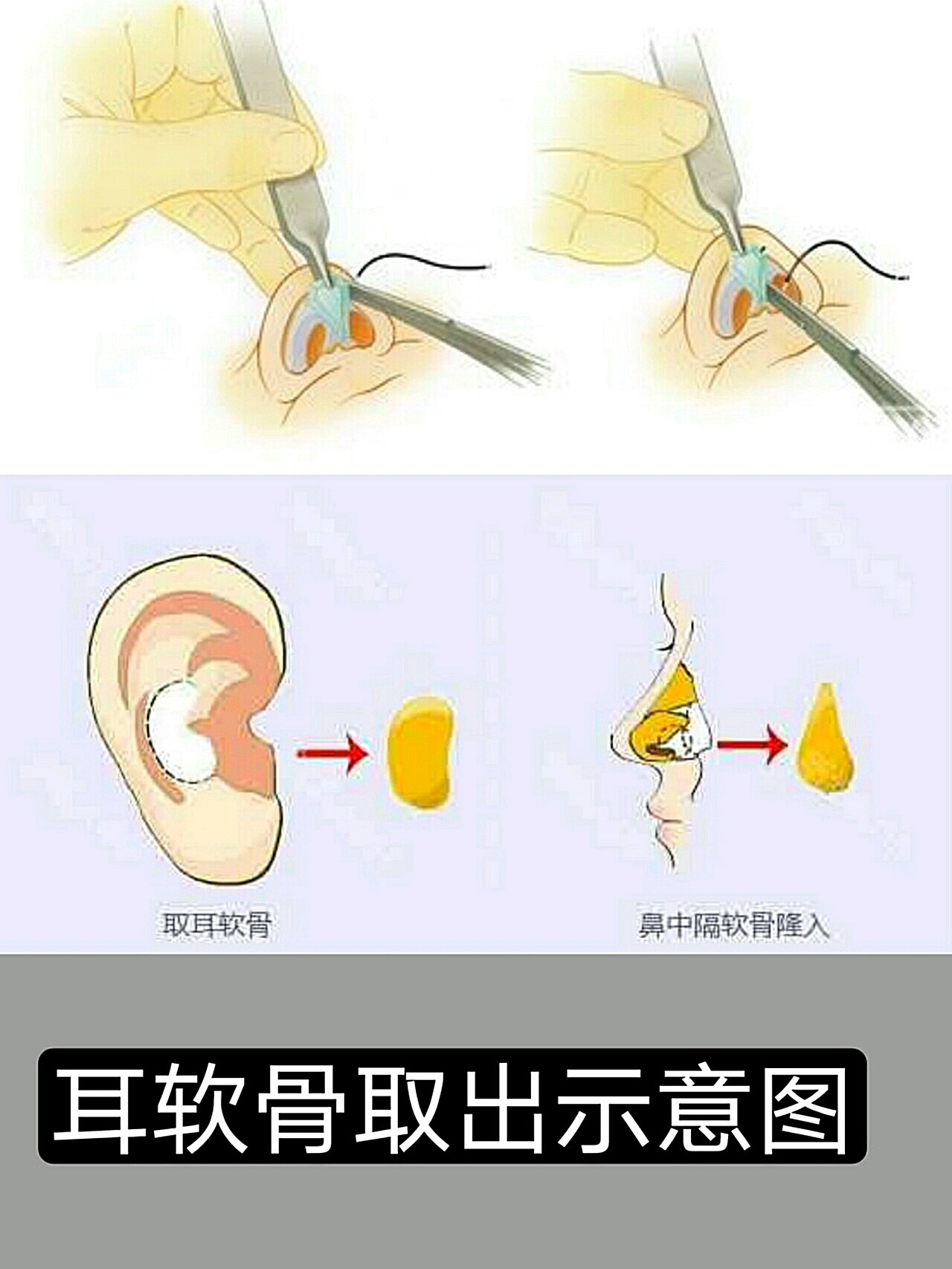 【取耳软骨,会损伤耳朵吗】