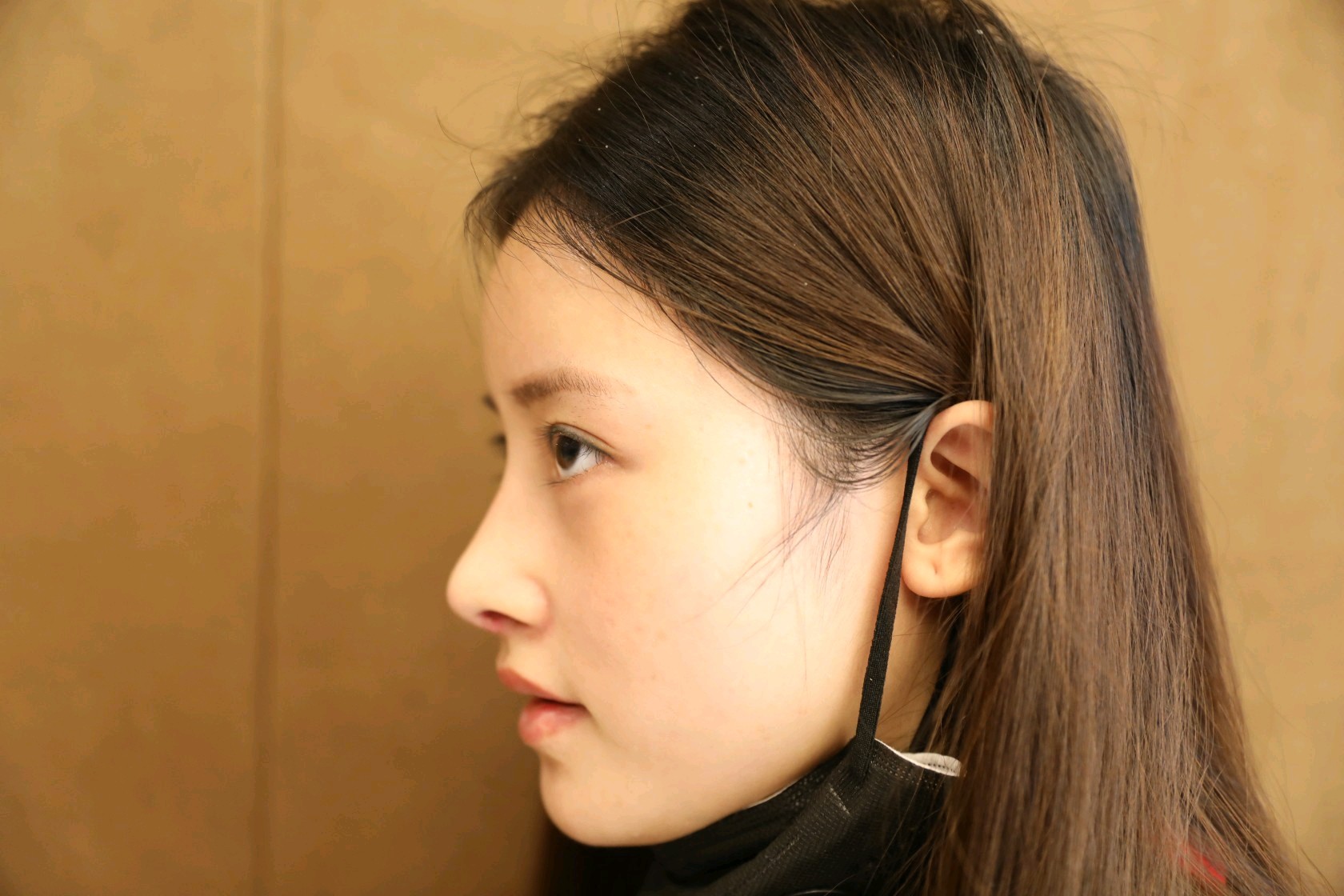 [重庆艺星 肋软骨隆鼻 第9天]