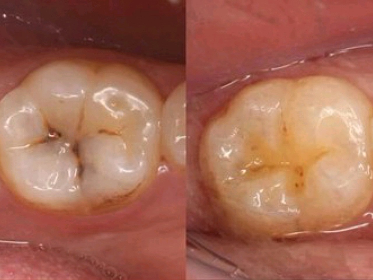 了有一个需要根管治疗一～四次看情况,搞完还需要做陶瓷牙套又得二千